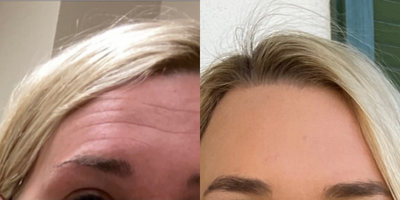 Botox before and after photo