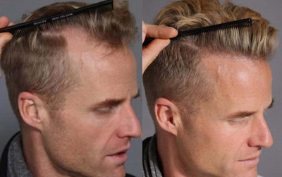 FUE Hair Transplant before and after photo
