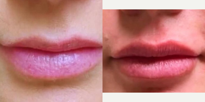 Lip Fillers before and after photo
