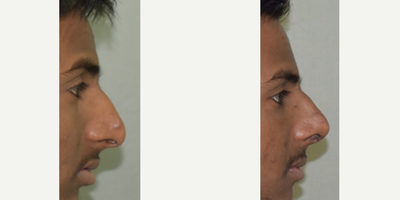 Rhinoplasty before and after photo
