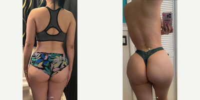 Brazilian Butt Lift before and after photo