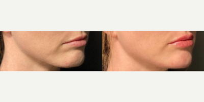 Chin Filler before and after photo