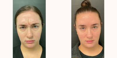 Dysport before and after photo