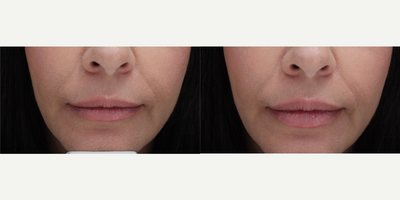 Lip Fillers before and after photo