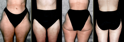 Liposuction before and after photo