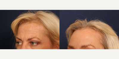 Brow Lift before and after photo