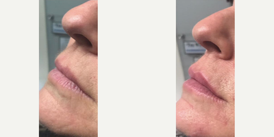Dermal Fillers before and after photo