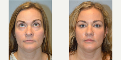 Facial Fat Transfer before and after photo