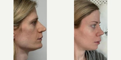 Facial Feminization Surgery before and after photo
