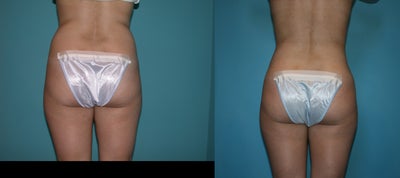 Liposuction before and after photo