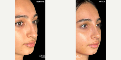 Rhinoplasty before and after photo