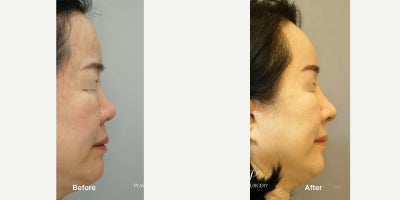 Rhinoplasty before and after photo