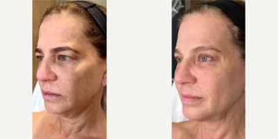 before and after image