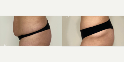 Tummy Tuck before and after photo