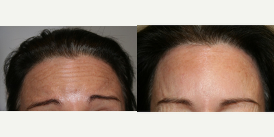 Botox before and after photo