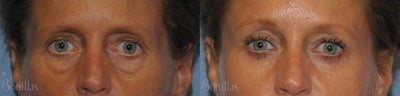 Eyelid Surgery before and after photo