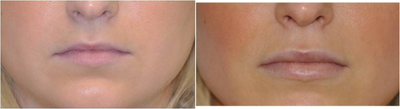 Lip Implants before and after photo