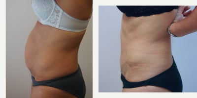 Liposuction before and after photo