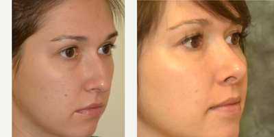 Rhinoplasty before and after photo