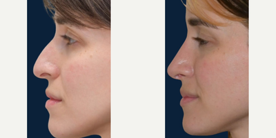 Rhinoplasty before and after photo