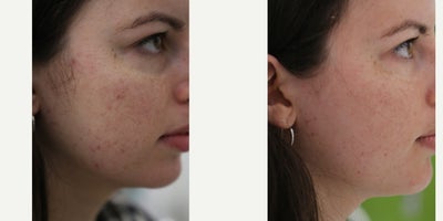 Vampire Facelift before and after photo