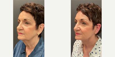 Brow Lift before and after photo