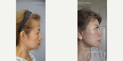 Brow Lift before and after photo
