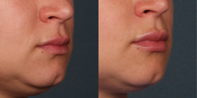 Dermal Fillers before and after photo
