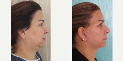 before and after image