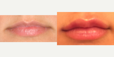 Restylane Silk before and after photo