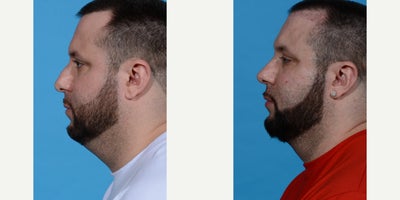 Rhinoplasty before and after photo