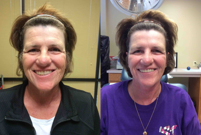 Botox before and after photo