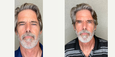 CO2 Laser before and after photo