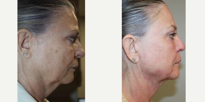 Smart Lipo before and after photo