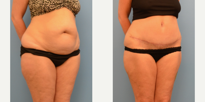 Tummy Tuck before and after photo