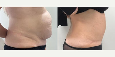 Tummy Tuck before and after photo