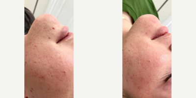 DiamondGlow before and after photo
