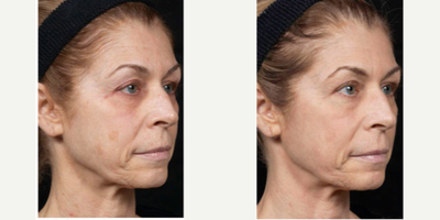 Fraxel Laser before and after photo