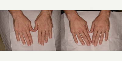 Radiesse before and after photo