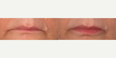 Juvederm before and after photo
