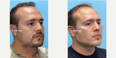 Dermal Fillers before and after photo