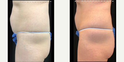 Emsculpt before and after photo