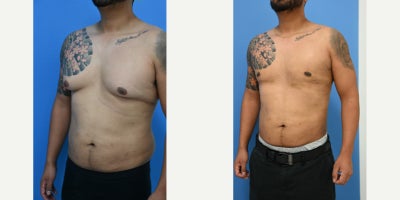 Gynecomastia Surgery before and after photo