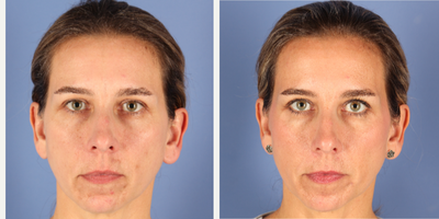 Halo Laser before and after photo