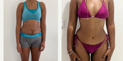 Liposuction before and after photo