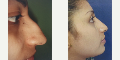 Rhinoplasty before and after photo