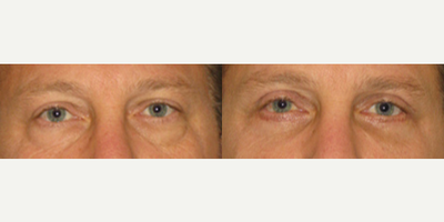 Eyelid Surgery before and after photo