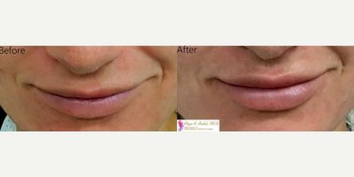 Juvederm before and after photo