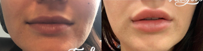 Lip Fillers before and after photo