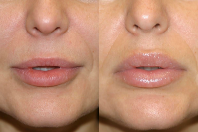 Lip Fillers before and after photo